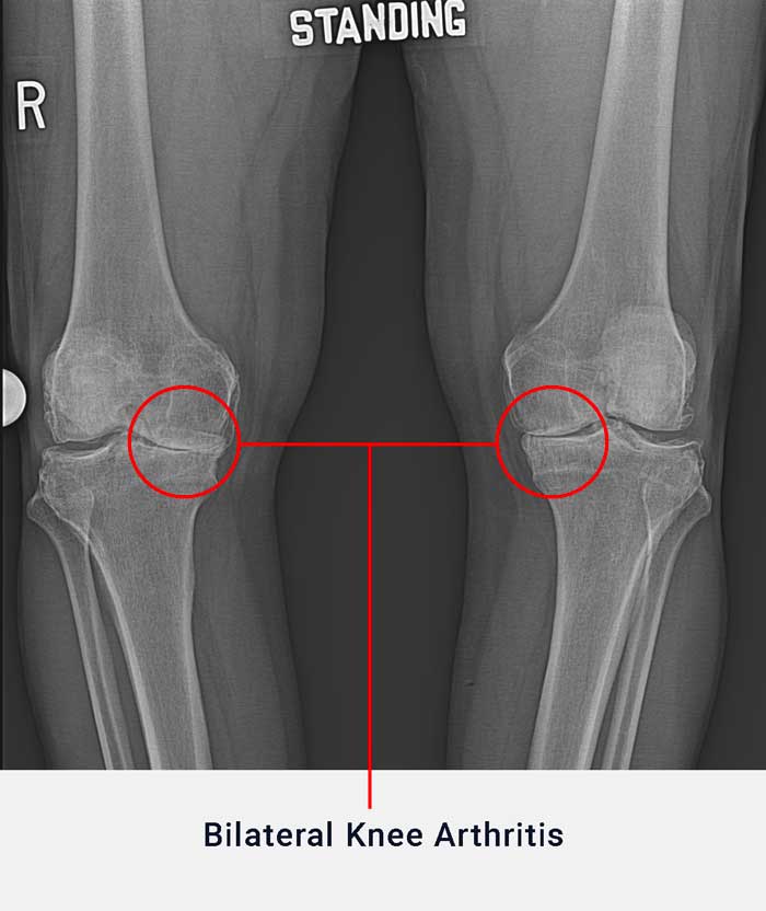 Bilateral Arthritis