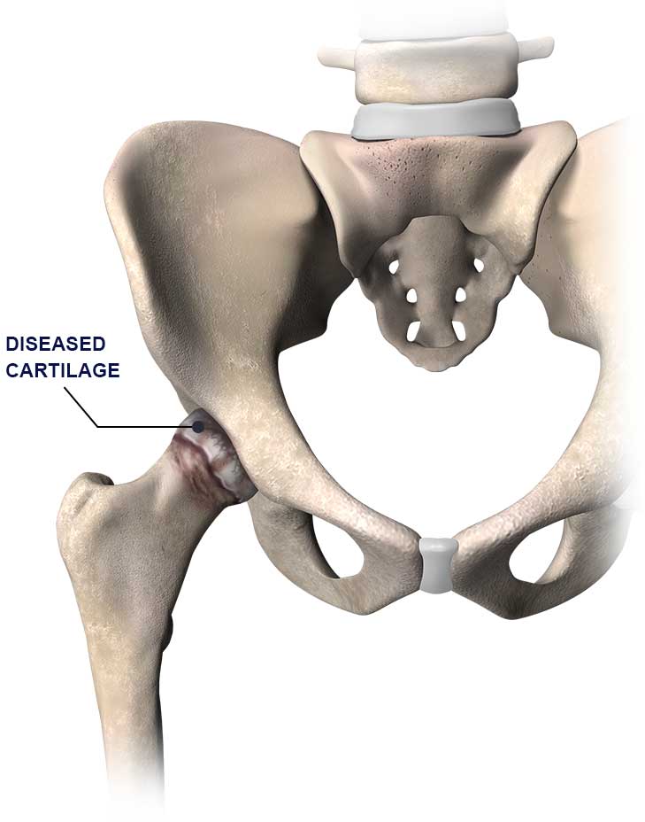 Anterior Approach Hip Replacement Offered by Top Orthopedic